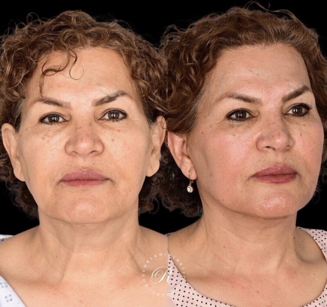 Facelift RPS Before & After.zip - 9