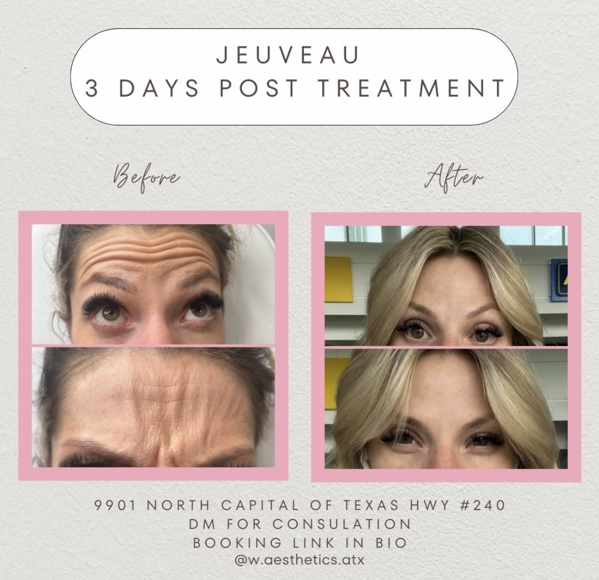 W Aesthetics Botox Before and After. Austin Texas8