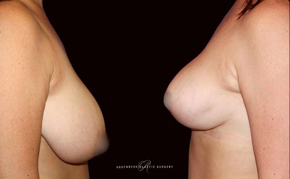 Breast Reduction and Lift Results
