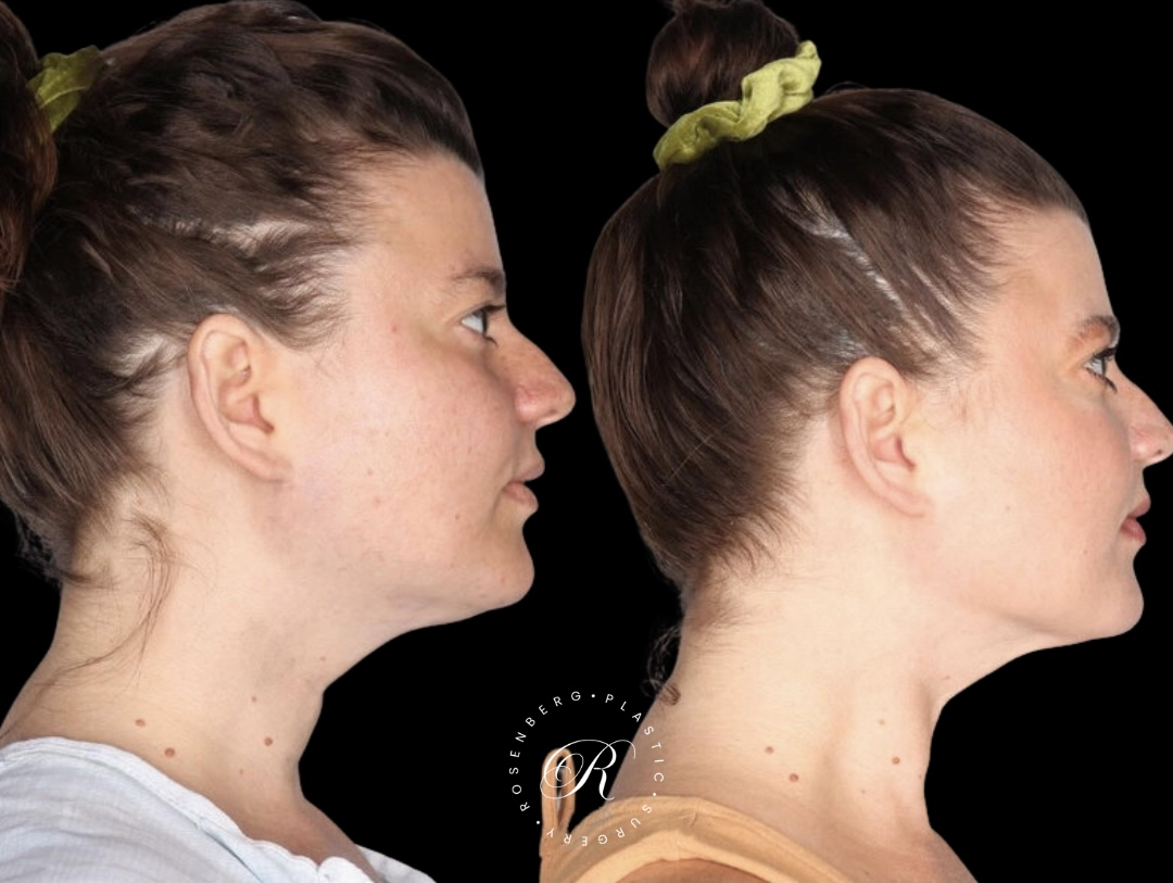 Neck Lipo RPS Before & After.zip - 4