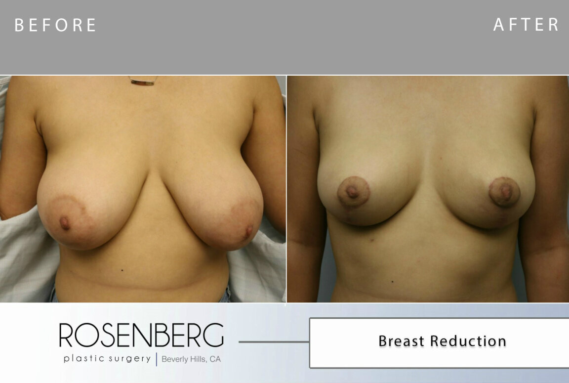 Kim Carney Breast Reduction B&A 2