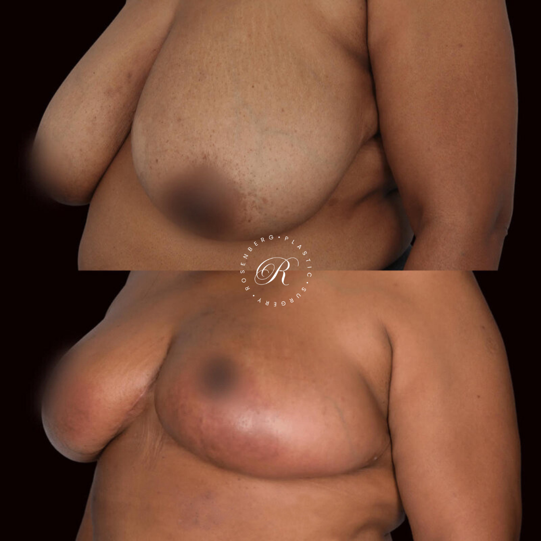 Breast Lift & Reduction RPS Before & Afters.zip - 19