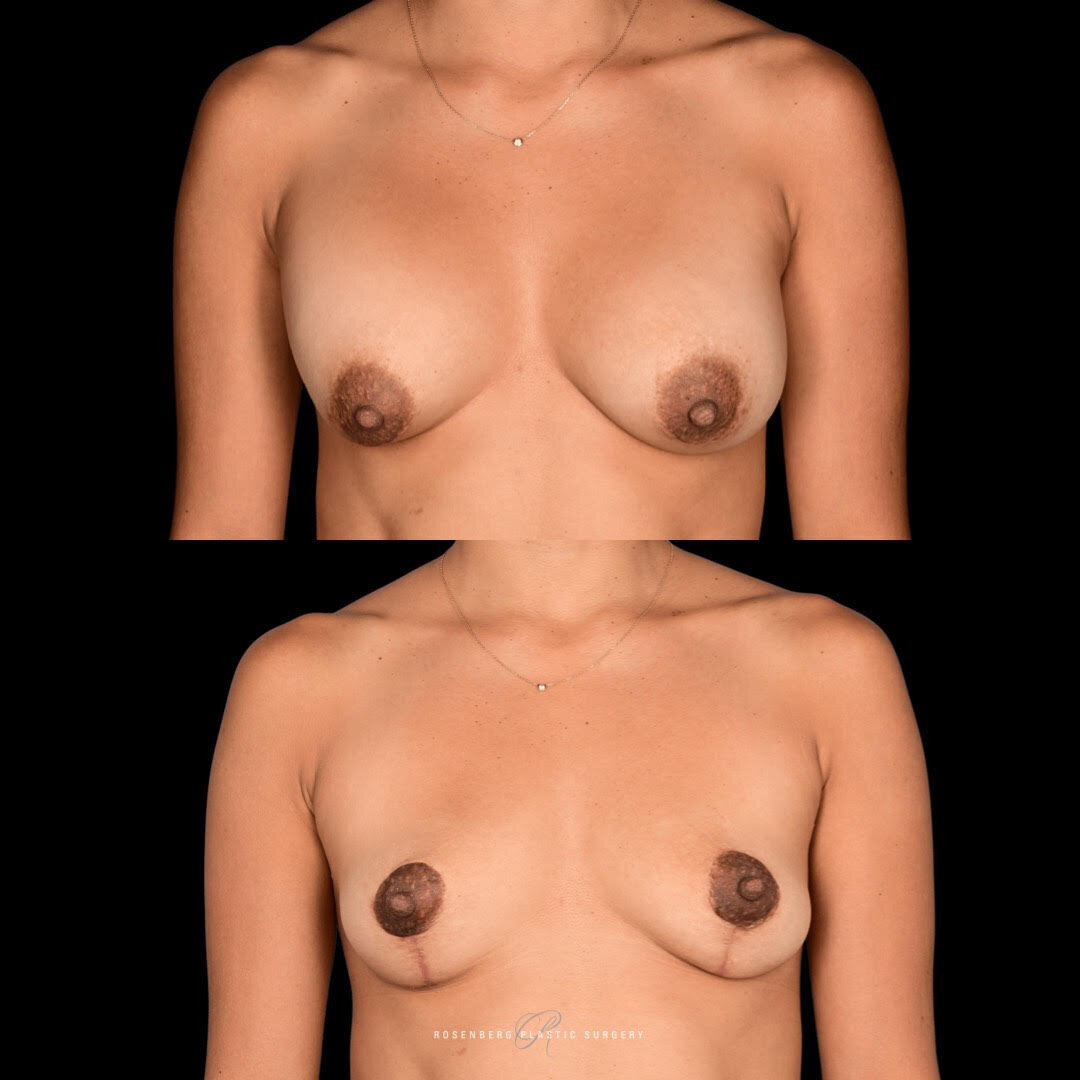 Breast Implant Removal Results