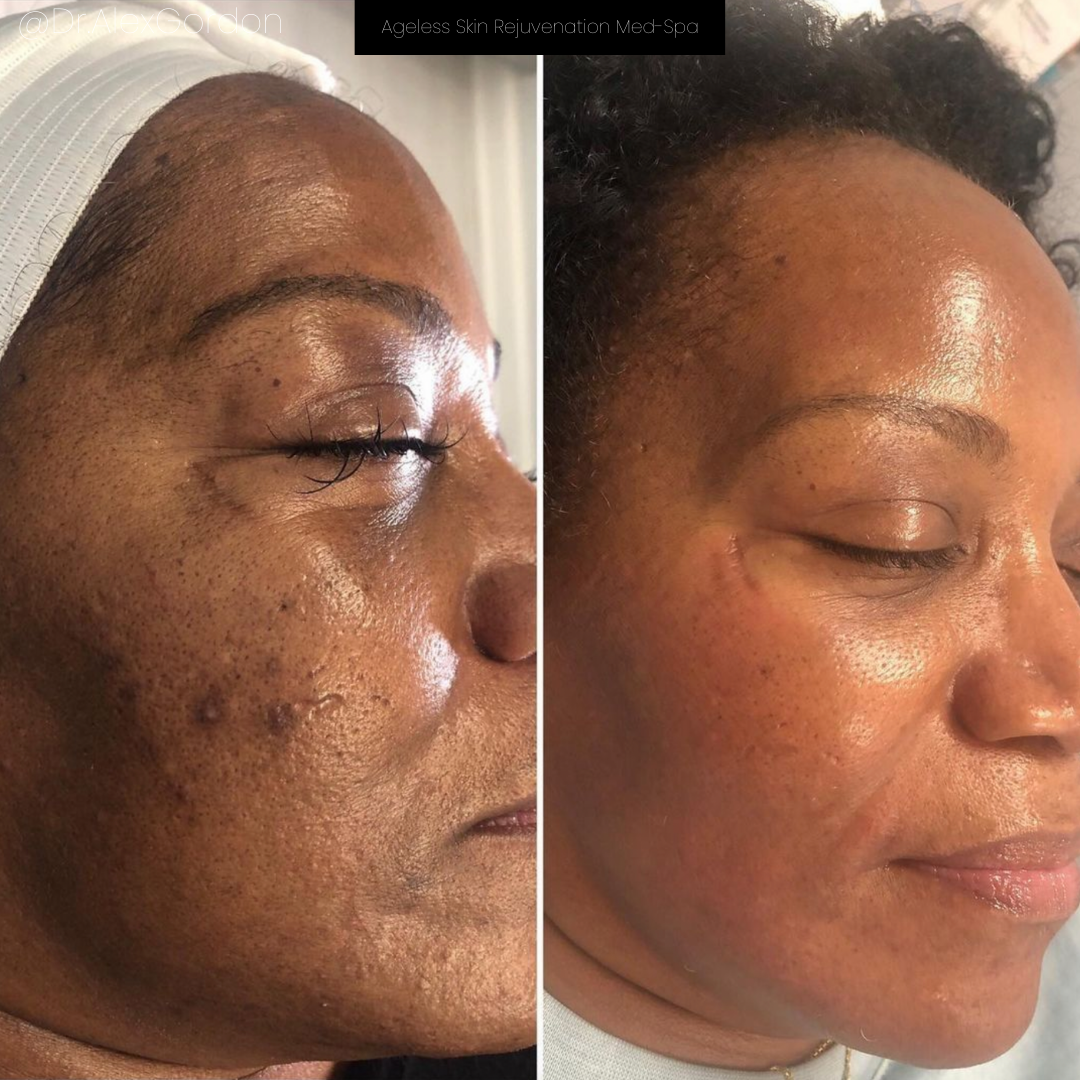 Neo Elite® - NeoSkin® - Skin Rejuvenation (SOC)