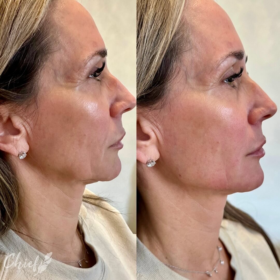 jawline-work-buffalo-ny-chief-aesthetics