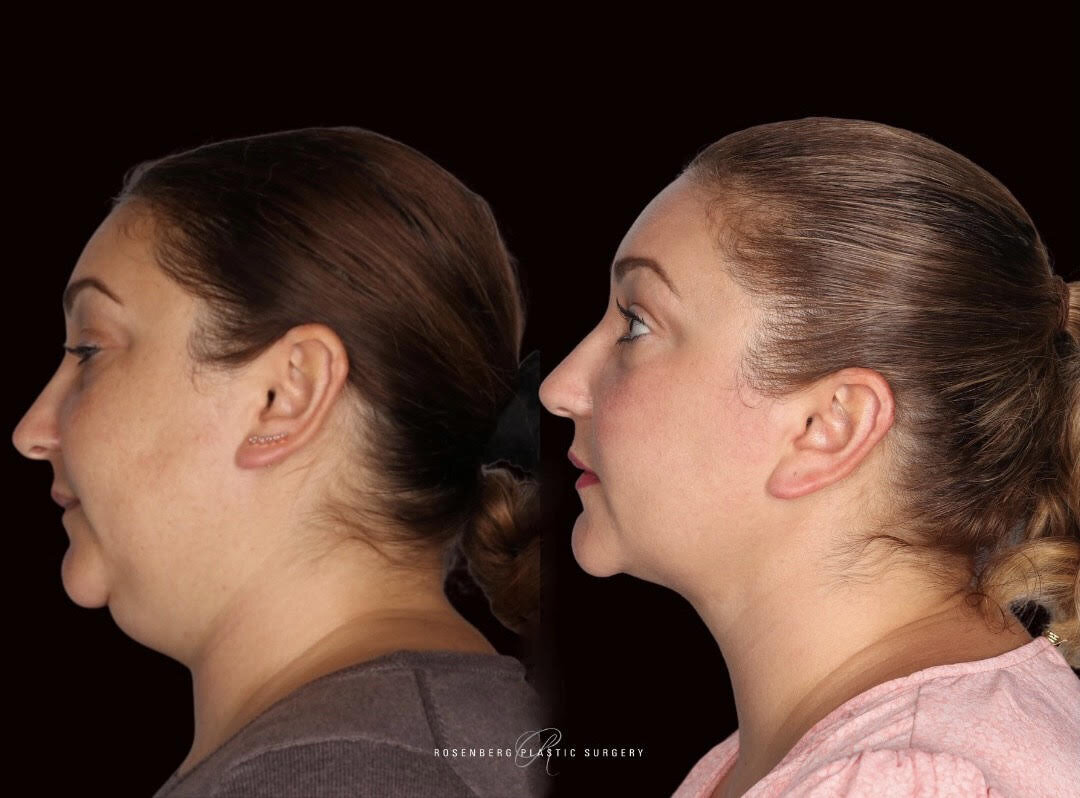 Neck Liposuction Results