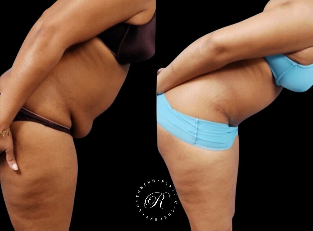 Abdominoplasty RPS Before & After.zip - 5