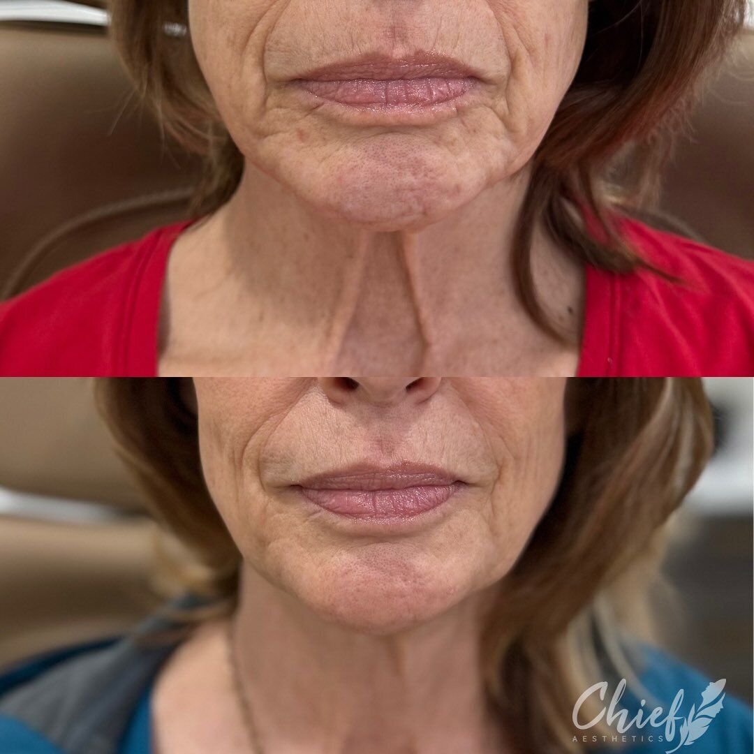 new-york-neck-rejuvination-tighten-muscles-anti-aging-aesthetic-treatment-before-and-after-by-chief-aesthetics