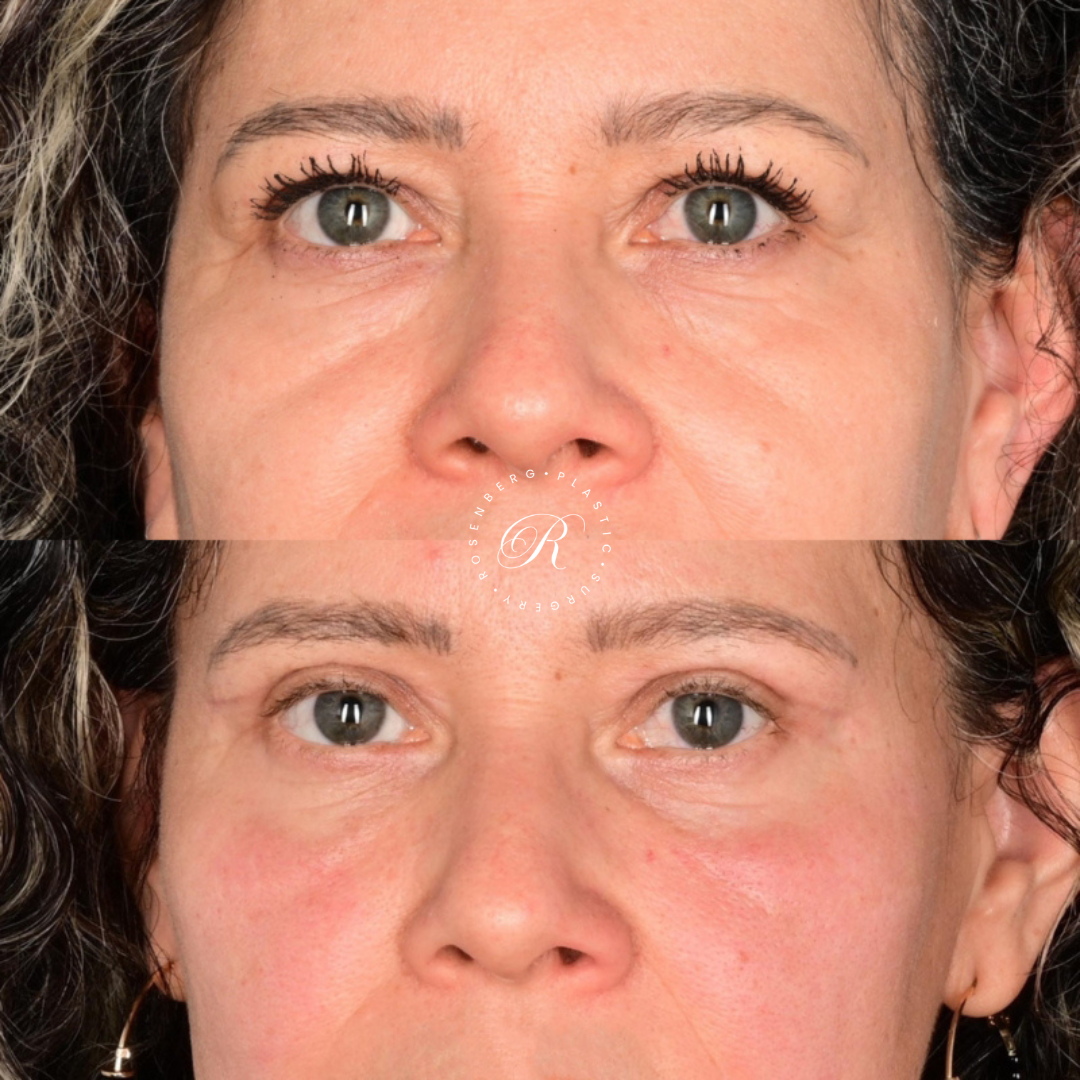 Blepharoplasty RPS Before & After.zip - 3