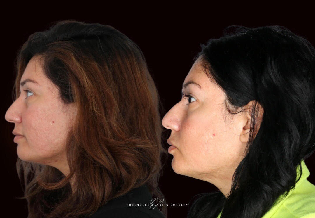 Picosure Hyperpigmentation