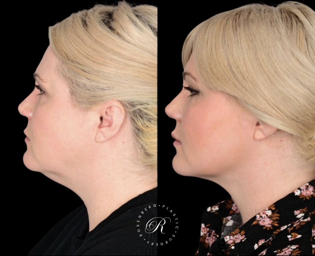Neck Lipo RPS Before & After.zip - 20