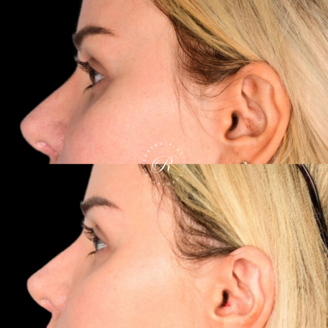 Blepharoplasty RPS Before & After.zip - 7