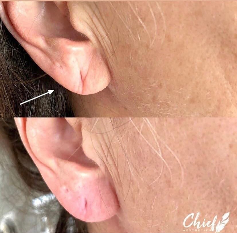 Earlobe-restoration-ny-chief-aesthetics