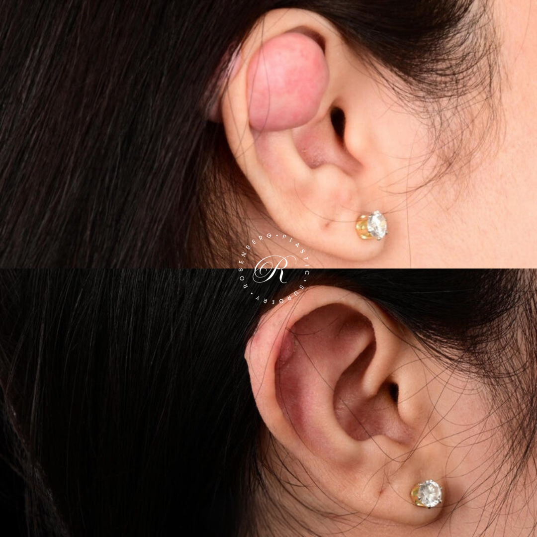 Keloid Removal RPS Before & After.png