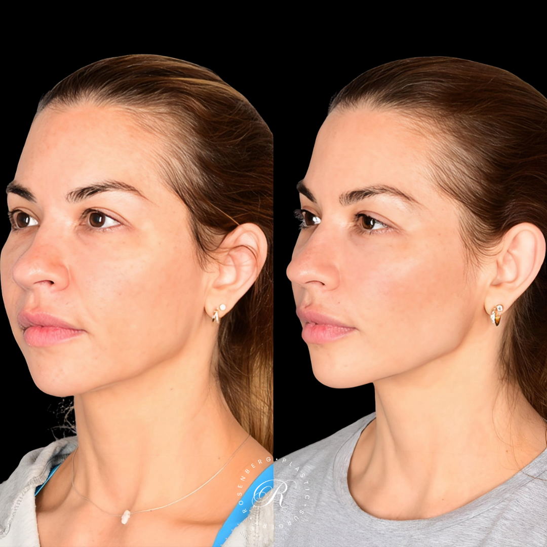 Buccal Fat Pad Removal RPS Before & After.zip - 5