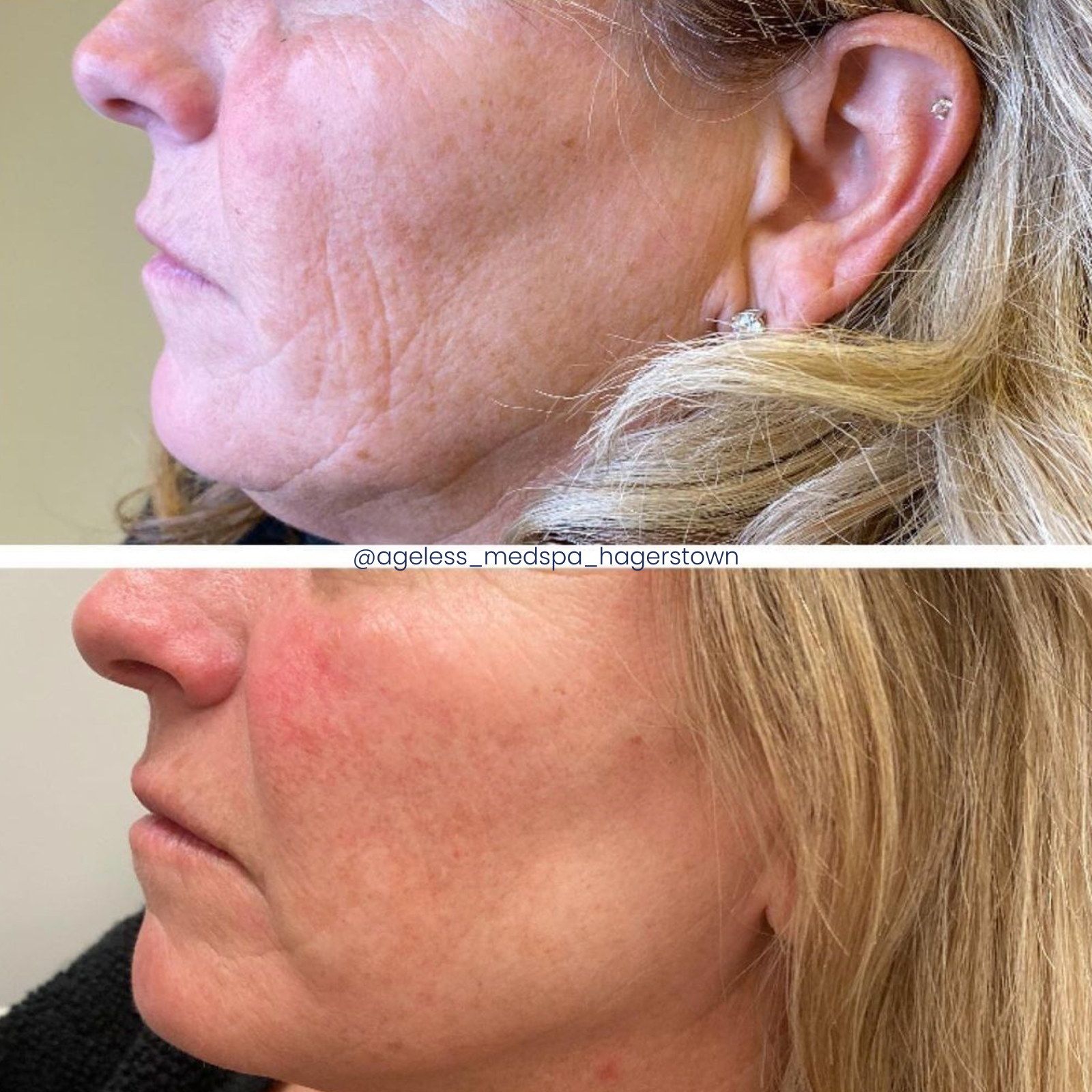 Neo Elite® - NeoSkin® - Skin Rejuvenation (4)