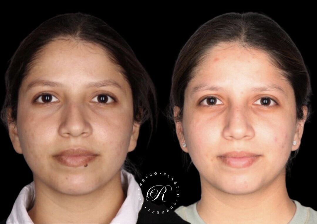 Mole Removal RPS Before & After.zip - 2