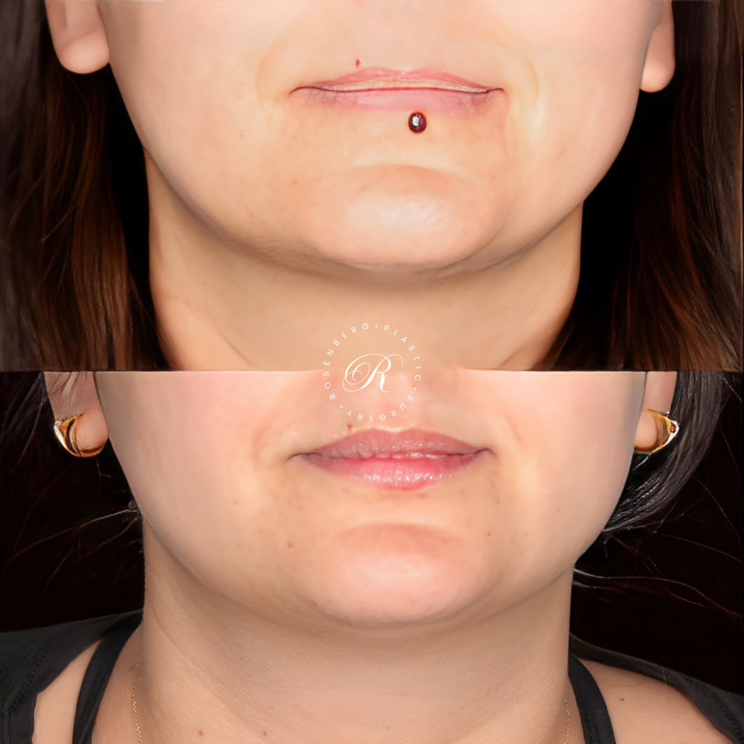 Mole Removal RPS Before & After.zip - 6