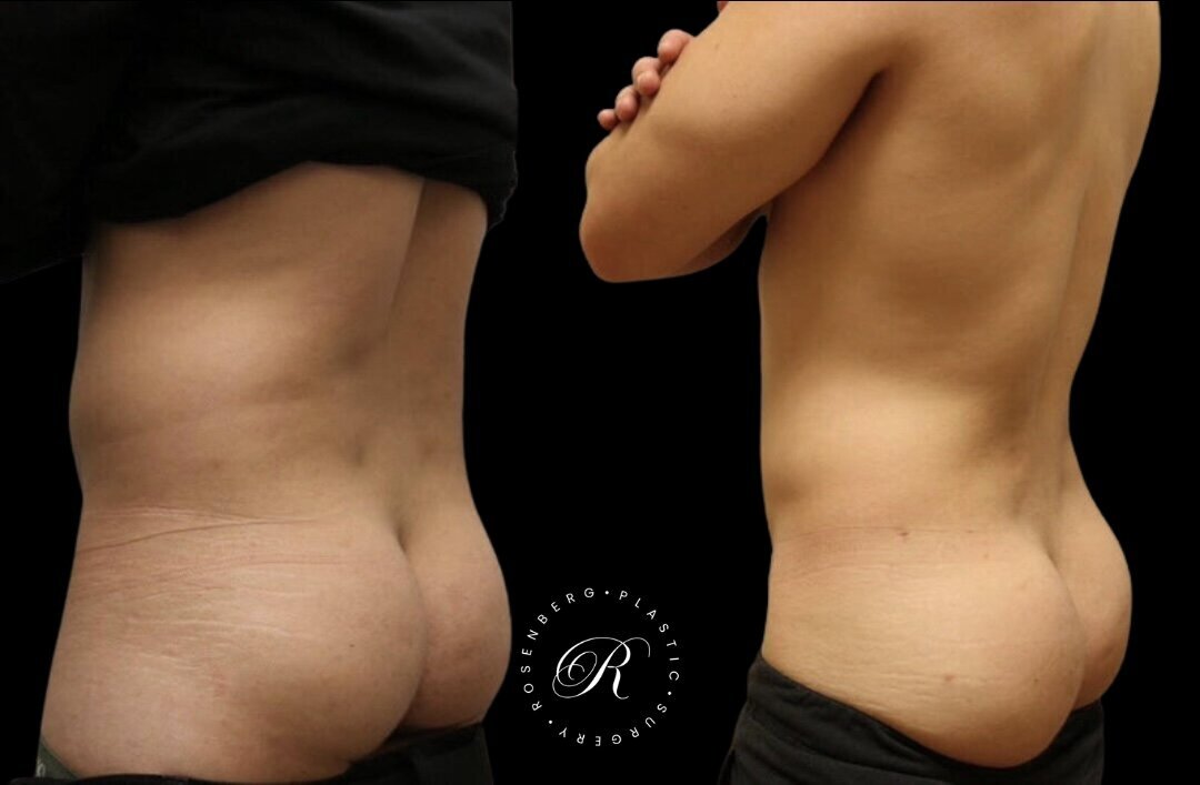 Liposuction of Abs, Back and Flanks RPS Before & After.zip - 5