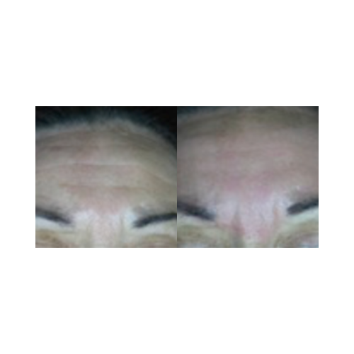 Wrinkle and fine line reduction after fractional CO₂ laser resurfacing