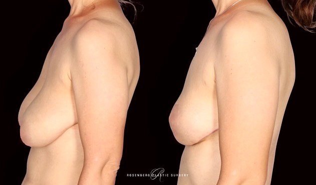 Breast Lift