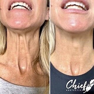 Nefertiti-Neck-lift-chief-aesthetics-ny