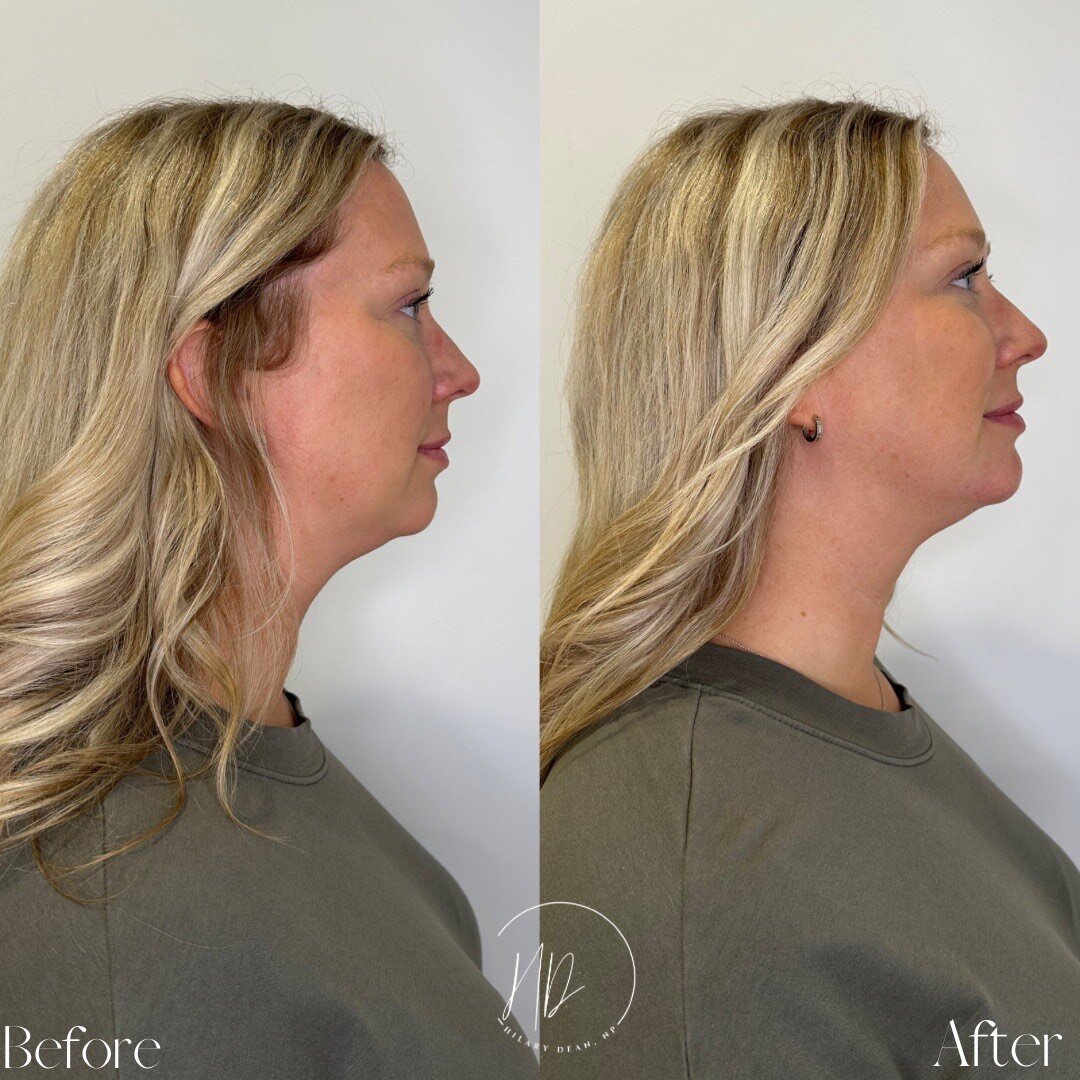 canova-aesthetics-med-spa-before-after-injectables-1