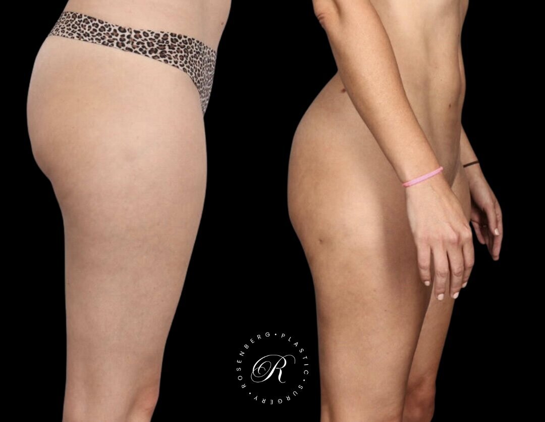 Liposuction of Abs, Back and Flanks RPS Before & After.zip - 6