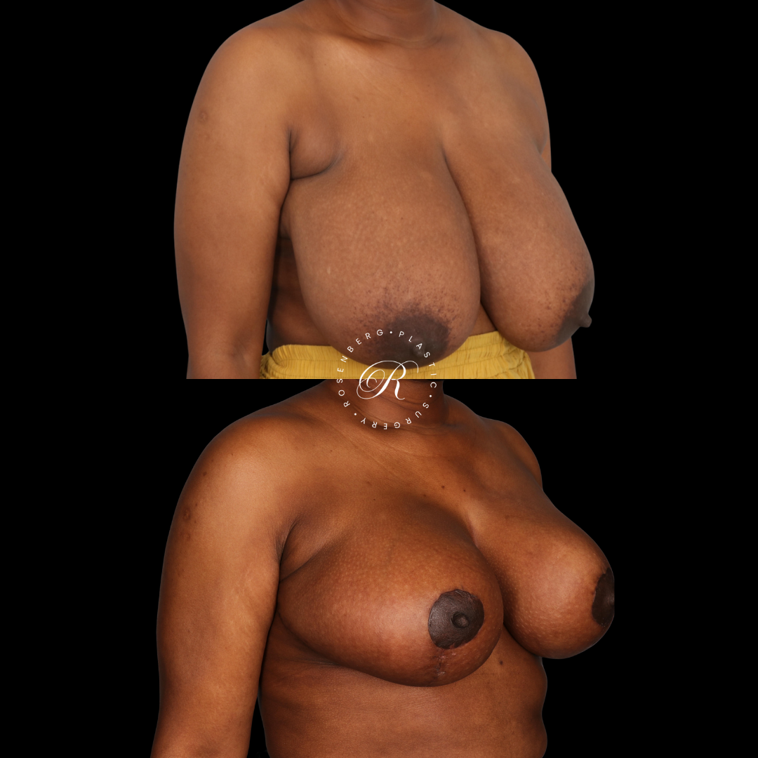 Breast Lift & Reduction RPS Before & Afters.zip - 5