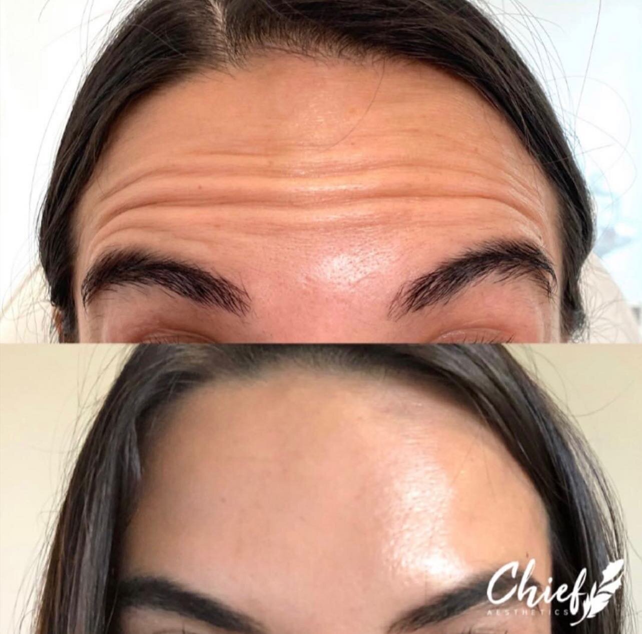 Botox:xeomin-buffalo-ny