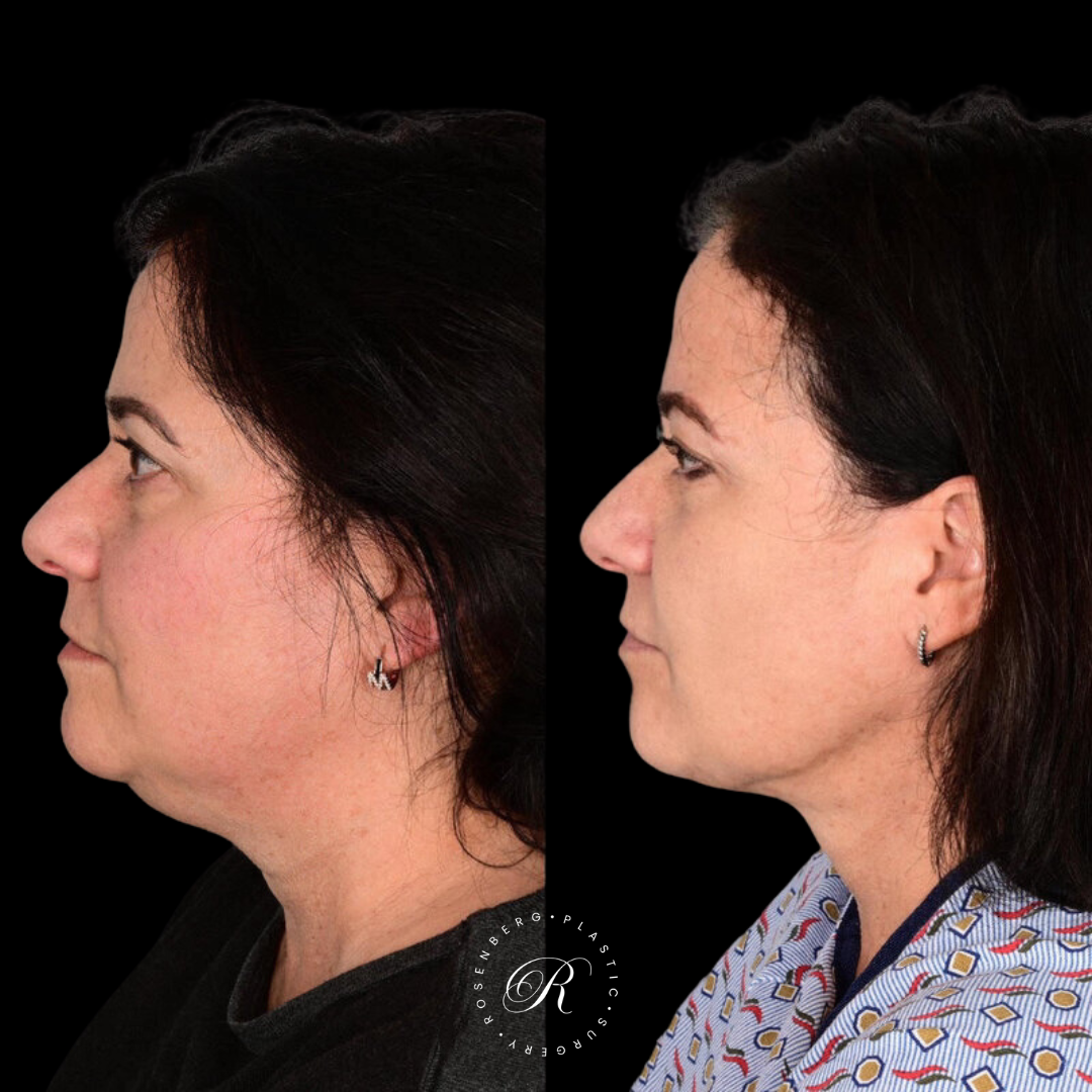 Neck Lipo RPS Before & After.zip - 16