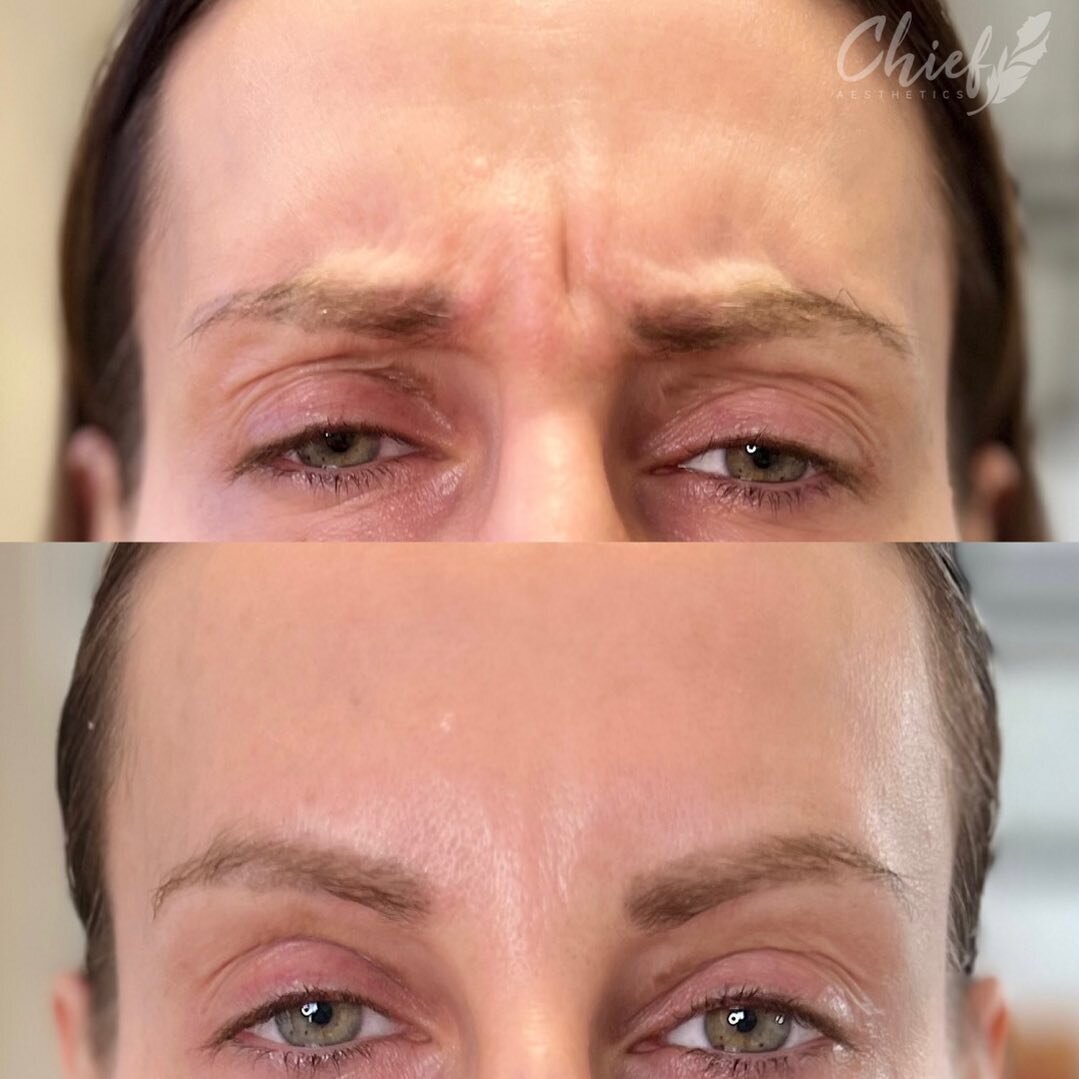 botox-before-after-williamsville-new-york-chief-aesthetics-1
