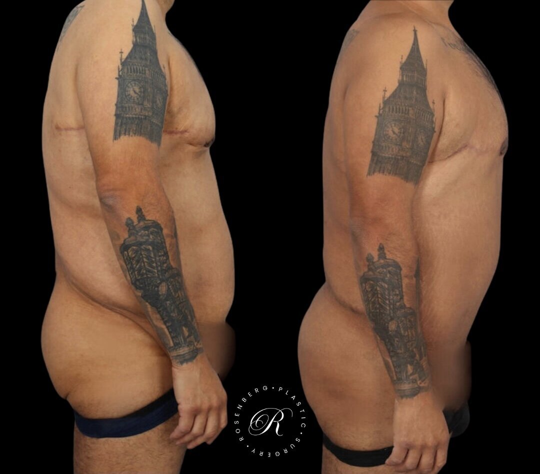 Panniculectomy RPS Before & After.zip - 3