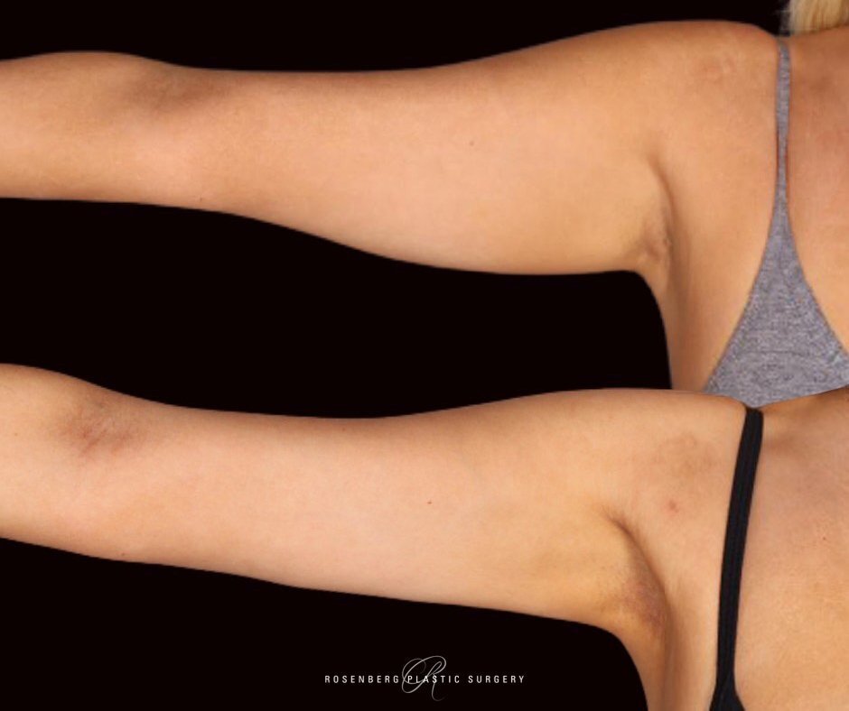 Arm Liposuction Results