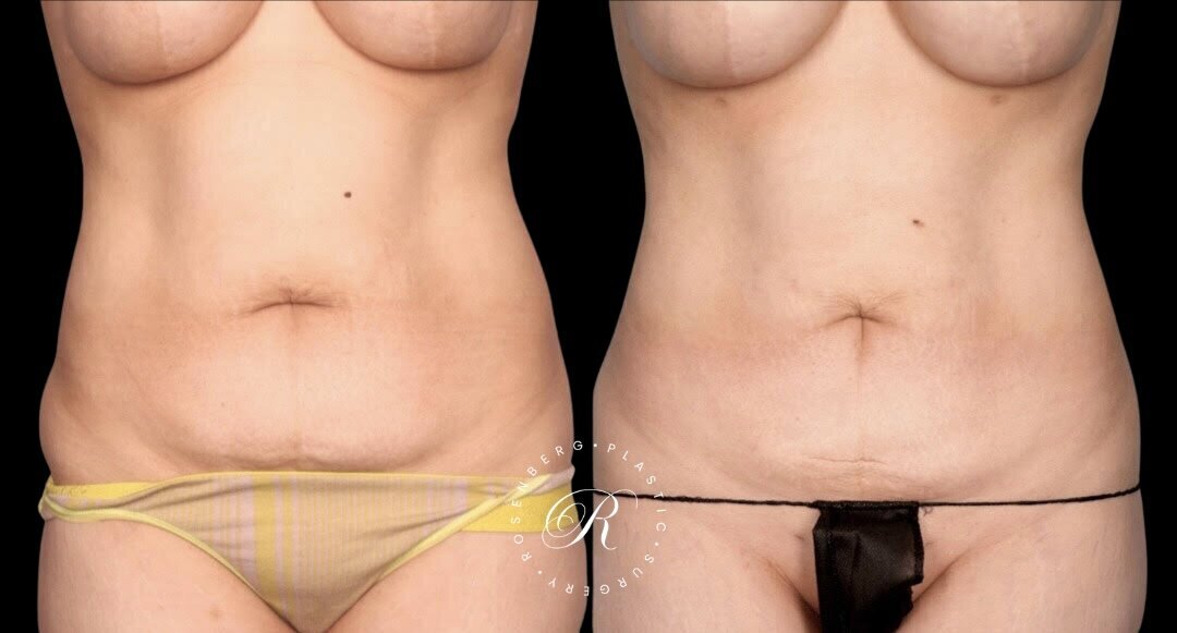 Liposuction of Abs, Back and Flanks RPS Before & After.zip - 1