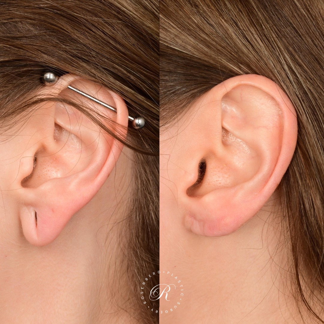 Earlobe Repair RPS Before & After.zip - 2