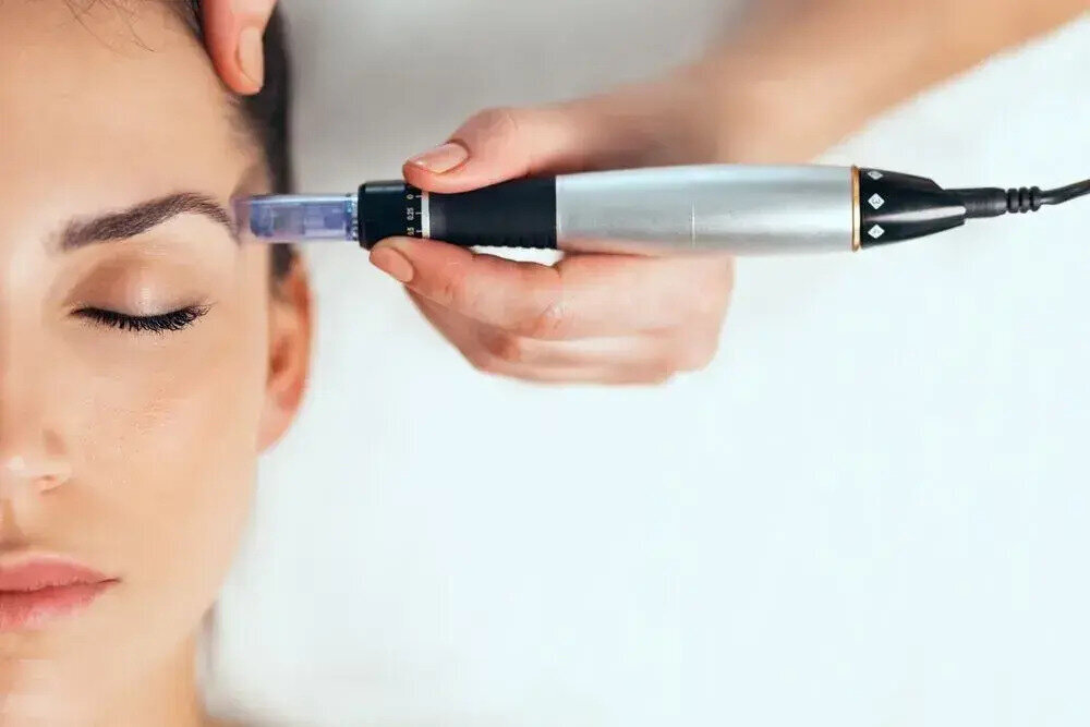 microneedling treatment on woman