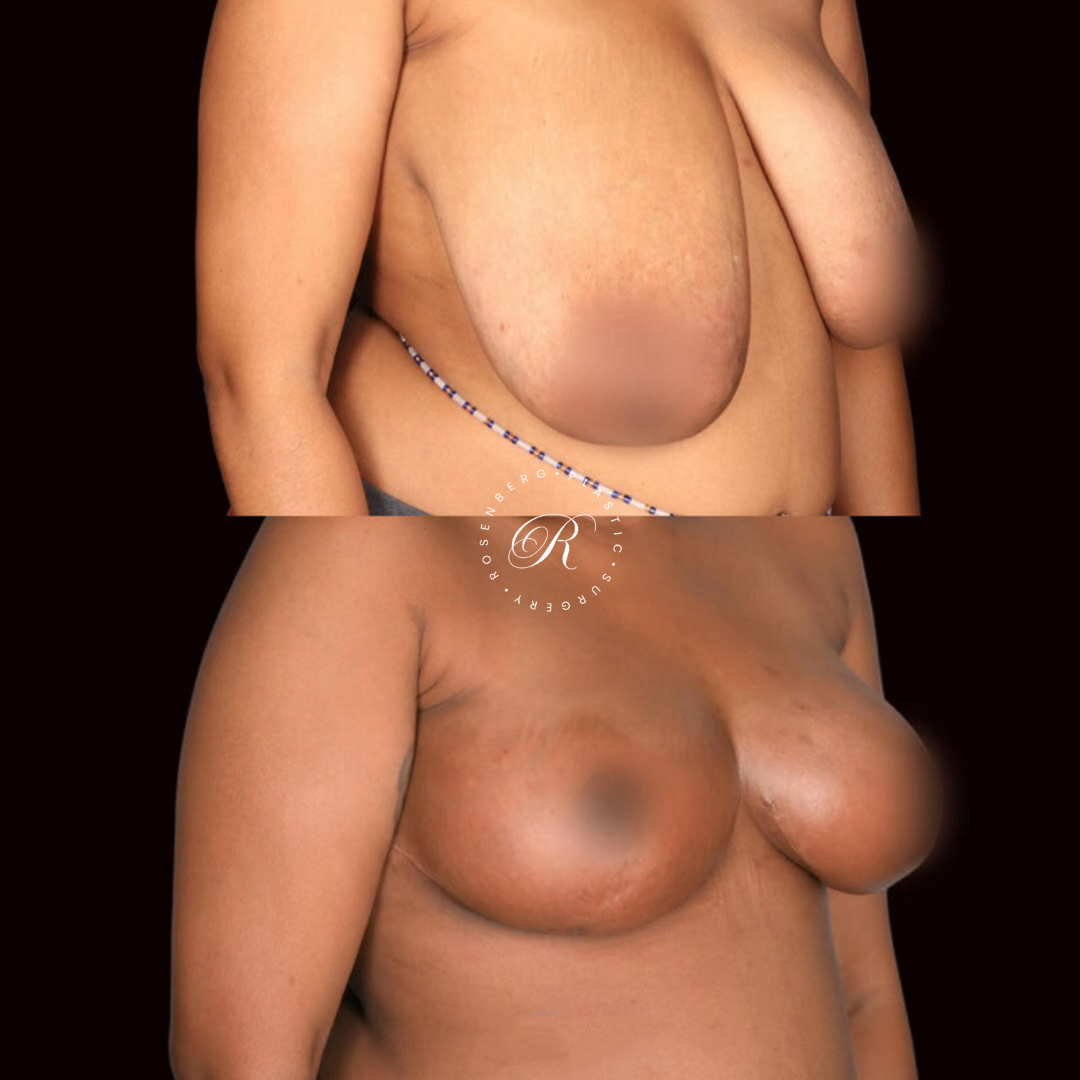 Breast Lift & Reduction RPS Before & Afters.zip - 26