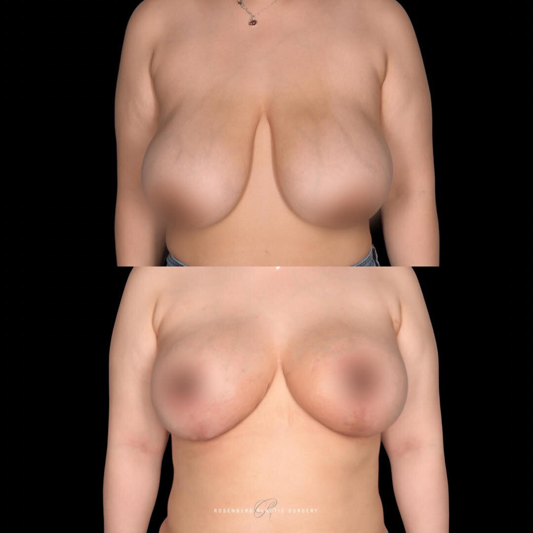 Breast Reduction and Lift Results