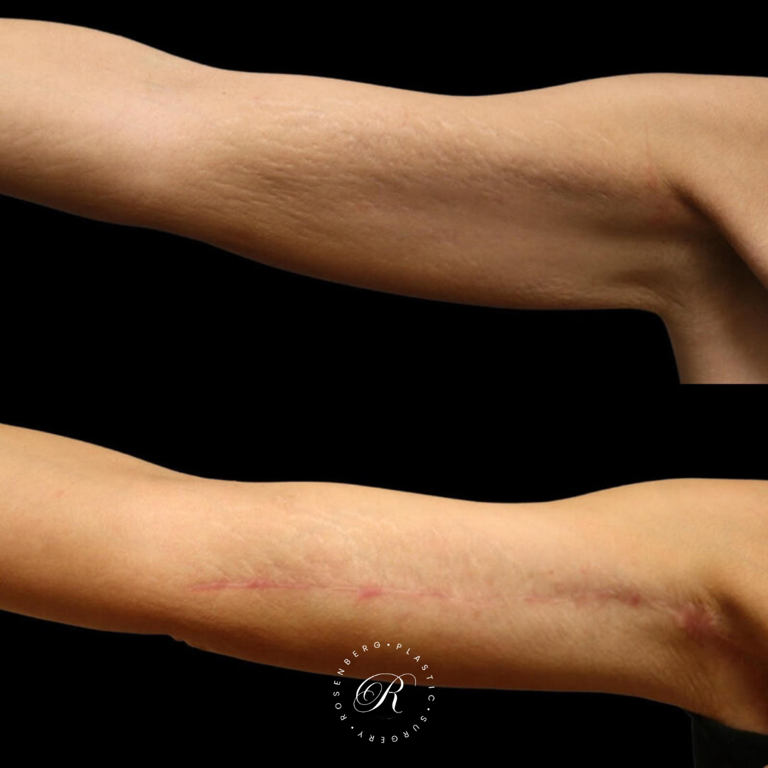 Brachioplasty RPS Before & After.png