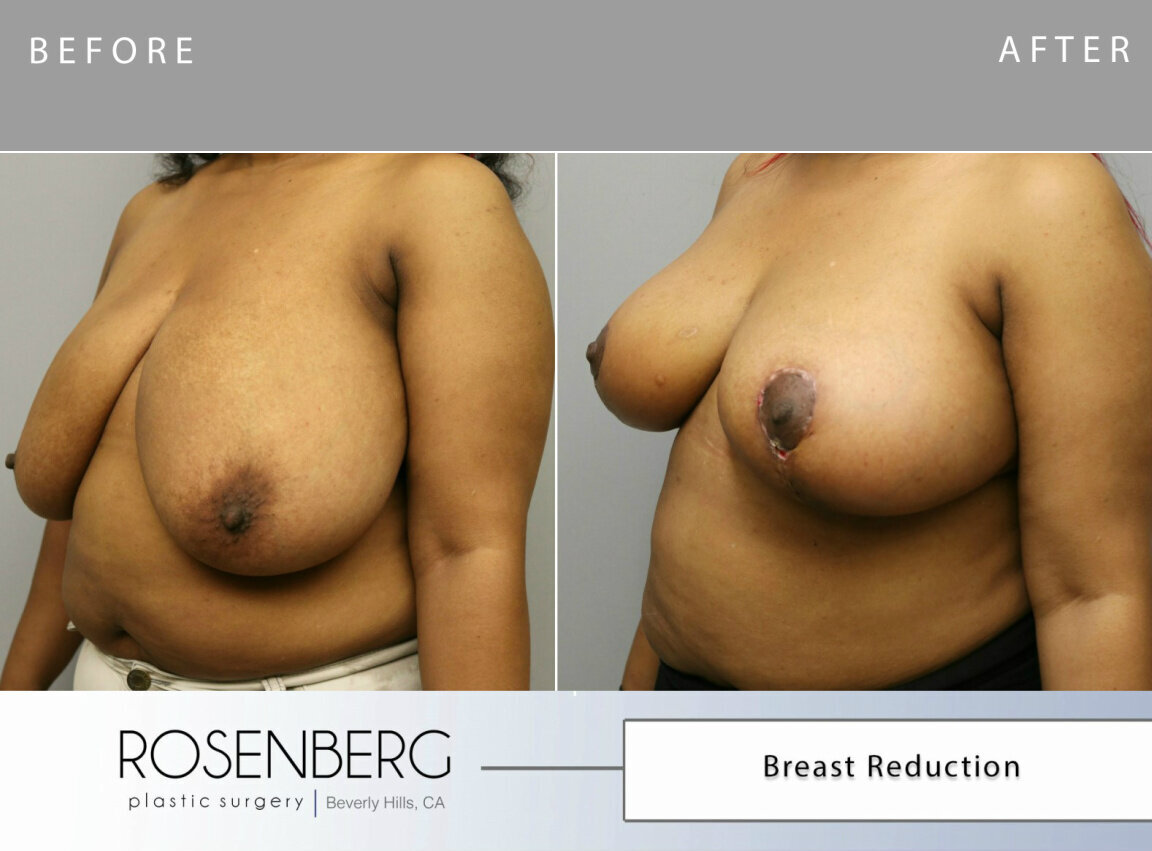 Shadonna Bailey Breast Reduction B&A  side 1