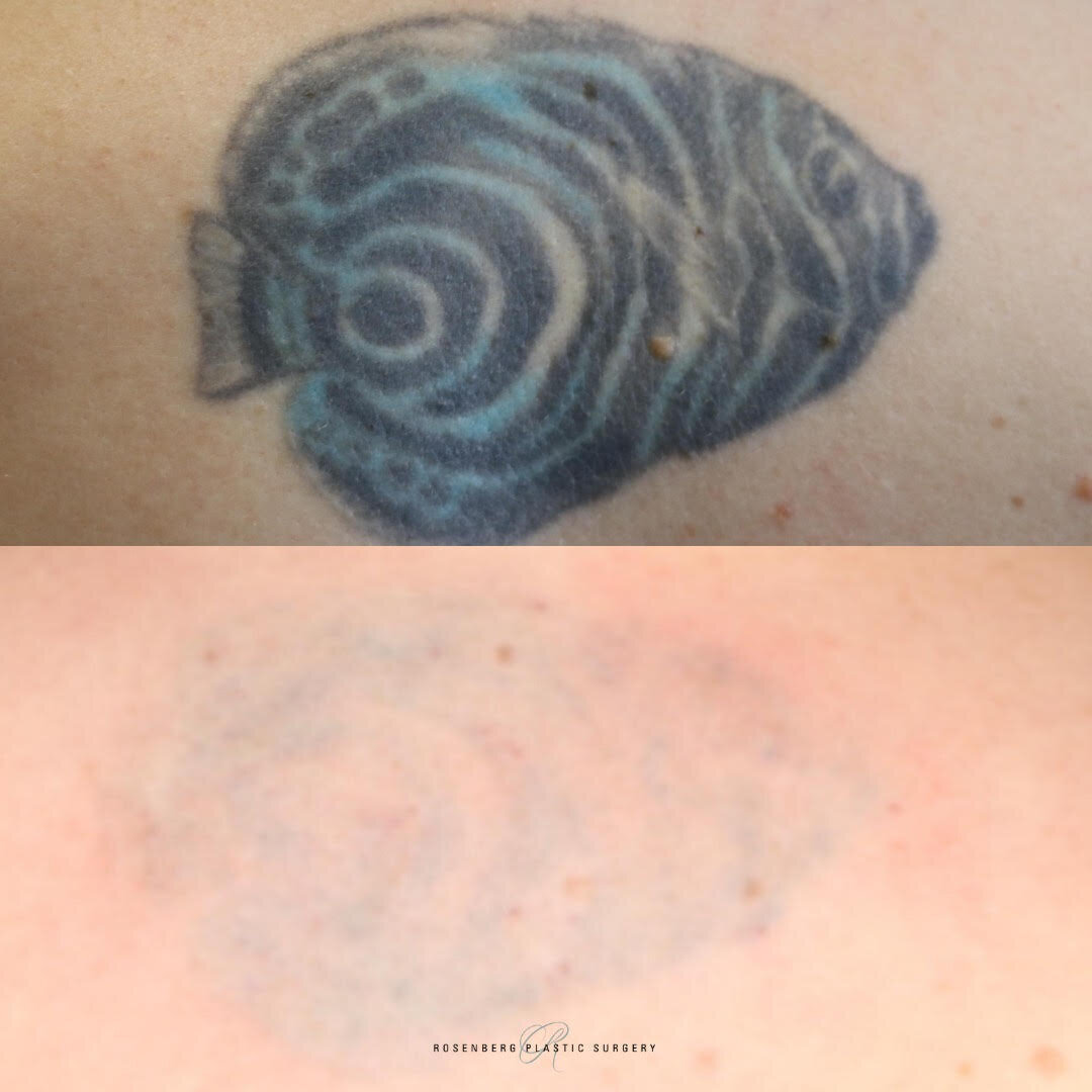 Tattoo Removal Results
