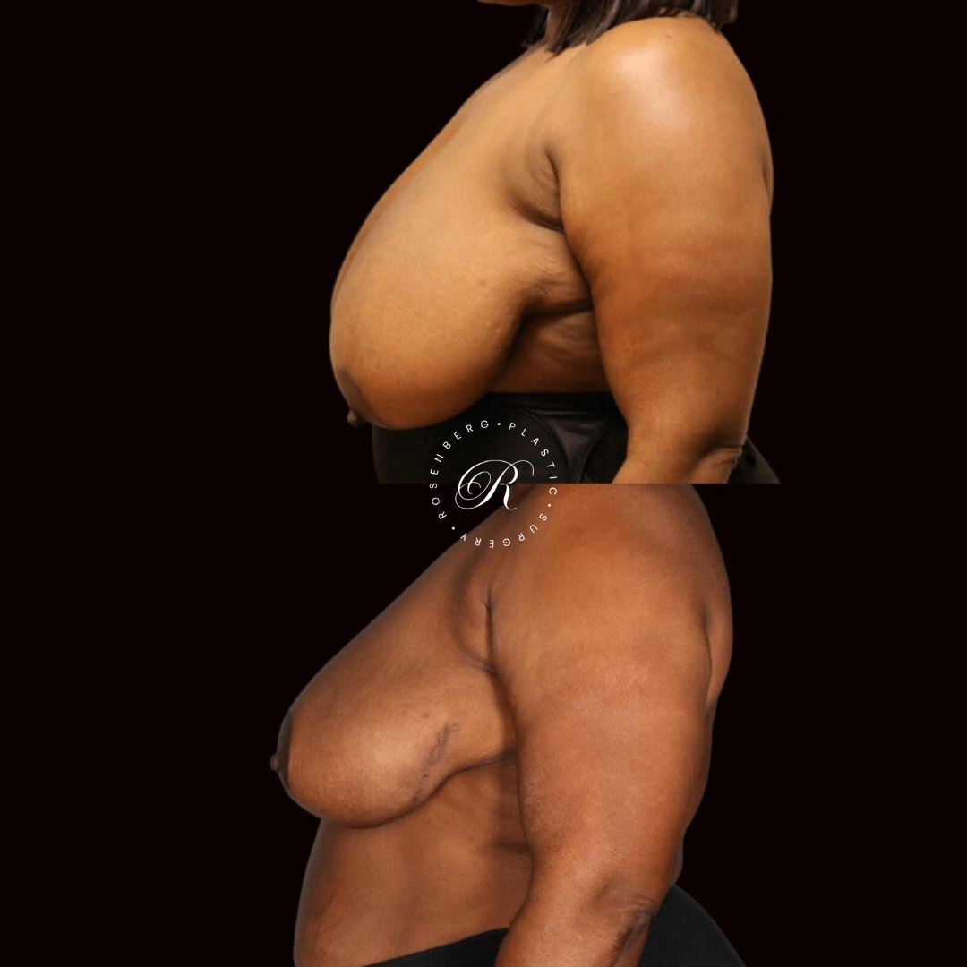 Breast Lift & Reduction RPS Before & Afters.zip - 13