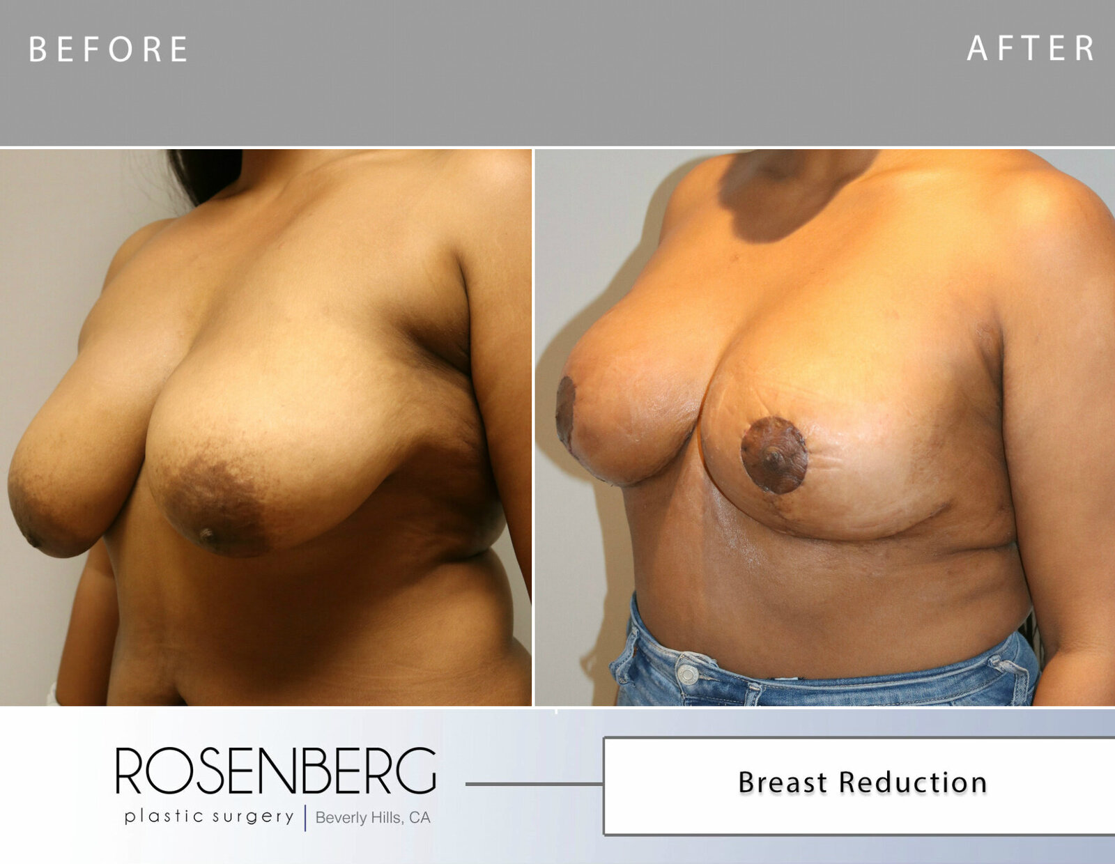 Germaine Breast Reduction Before 2