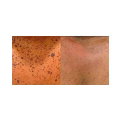 Pigmented lesion removal results post KTP laser session