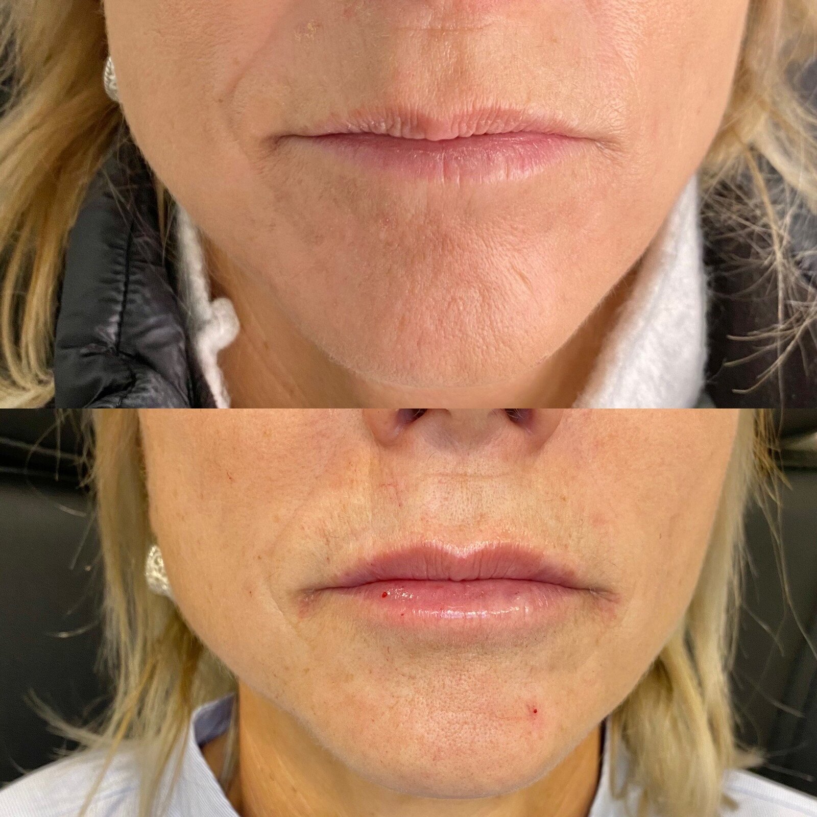 canova-aesthetics-med-spa-before-after-injectables-4