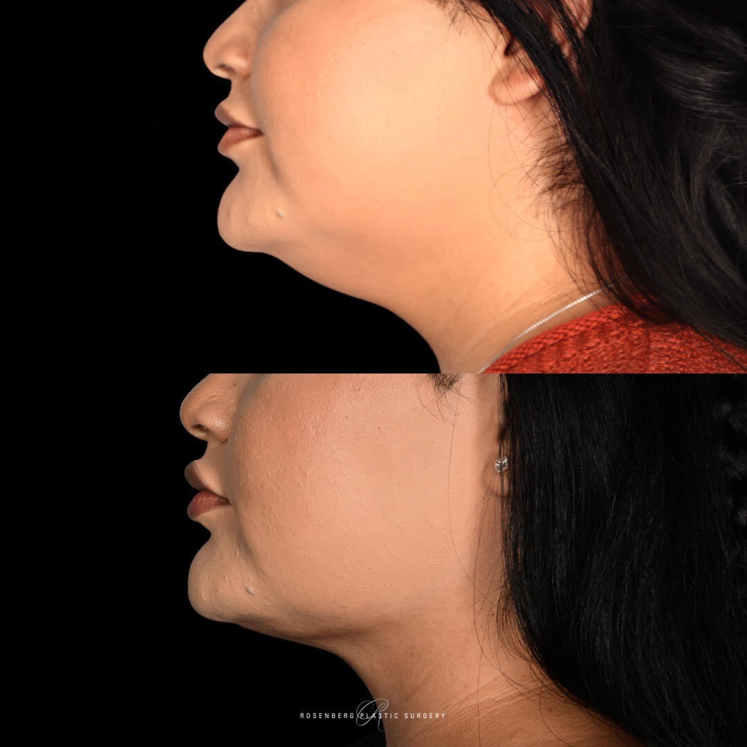 Neck Liposuction Results