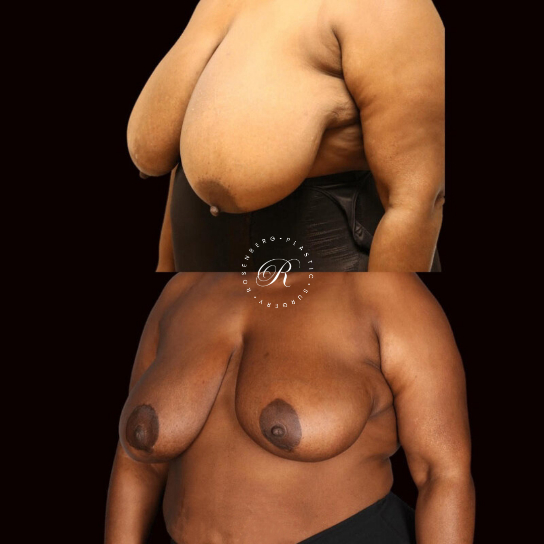 Breast Lift & Reduction RPS Before & Afters.zip - 12