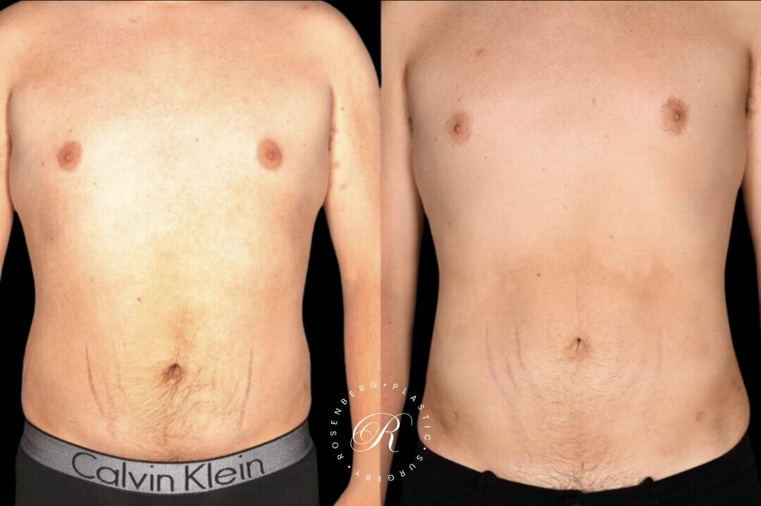 Liposuction of Abs, Back and Flanks RPS Before & After.zip - 9