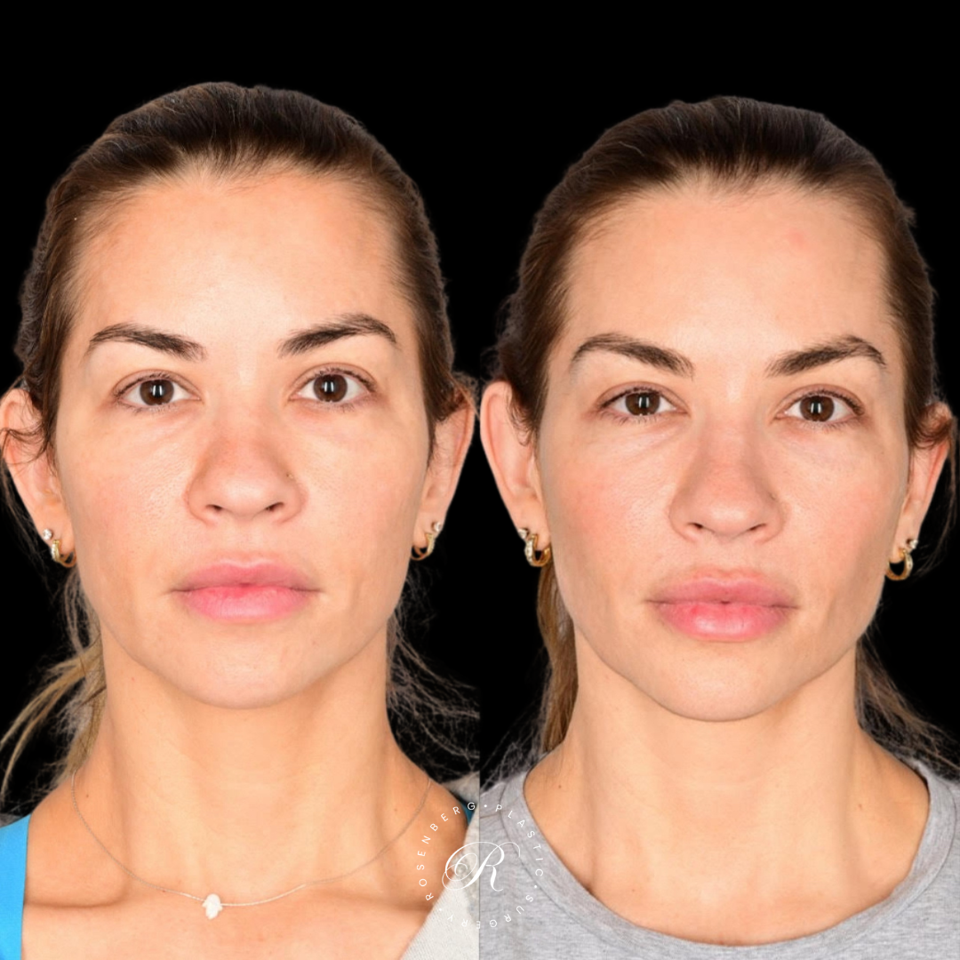 Buccal Fat Pad Removal RPS Before & After.zip - 4